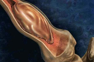 костная киста