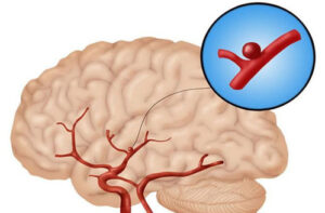 аневризма головного мозга