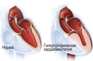 гипертрофическая кардиомиопатия