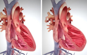 сердечная недостаточность