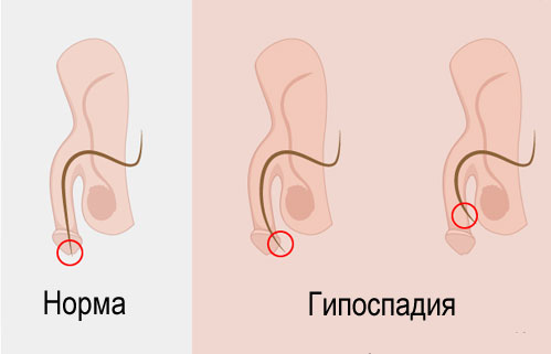 Артериогенная эректильная дисфункция