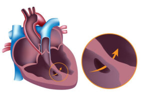 Лечение порока сердца в Израиле