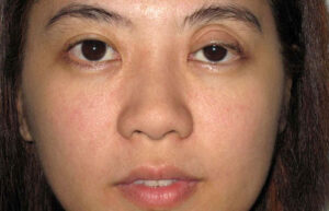 птоз верхнего века