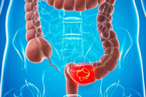 лечение рака толстого кишечника за рубежом
