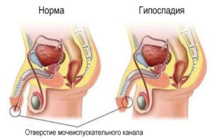 Лечение гипоспадии в Израиле