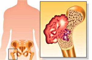 Лечение саркомы костных тканей за рубежом
