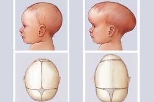 краниостеноз