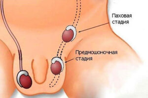крипторхизм
