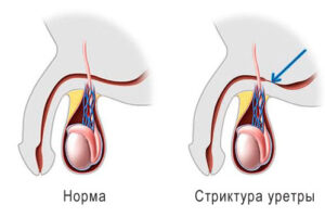 стриктура уретры
