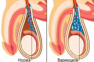 варикоцеле