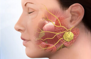 Лечение рака слюнной железы в Израиле