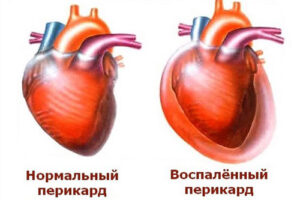 перикардит