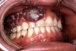 саркома Капоши