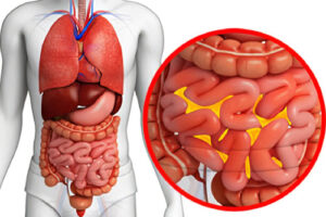 Лечение перитонита в Израиле