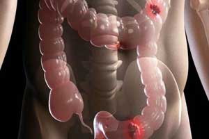 рак слепой кишки