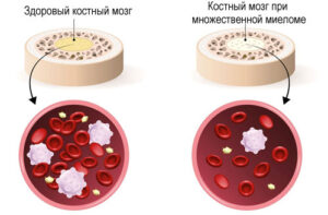 Лечение множественной миеломы в Израиле