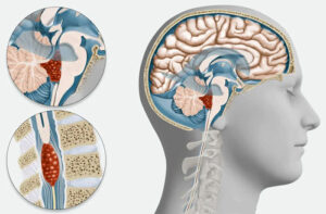 Лечение эпендимомы в Израиле