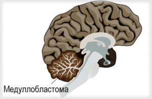 Медуллобластома