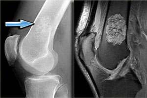 энхондрома