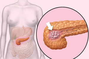 глюкагонома