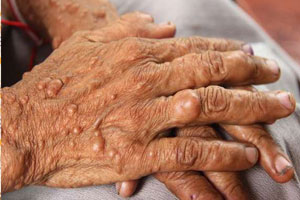 нейрофиброматоз