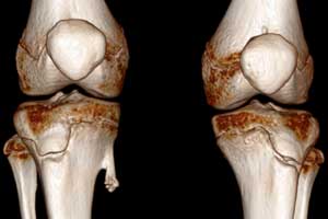 остеохондрома