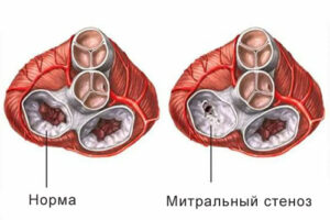 митральный стеноз