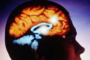 арахноидит