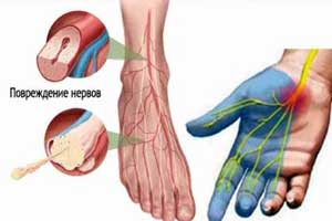 полинейропатия