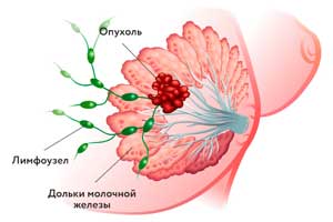 рак Педжета