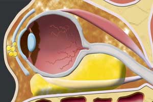 лимфангиома