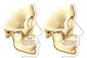синдром Крузона