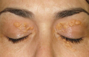 ксантелазма