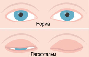 лагофтальм