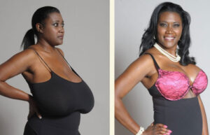 макромастия