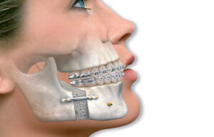 лечение синдрома агнатии