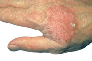 болезнь Боуэна