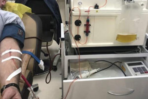 Плазмаферез