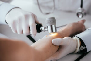 Лечение меланоза Дюбрейля в Израиле