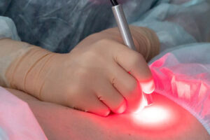 Фотодинамическая терапия