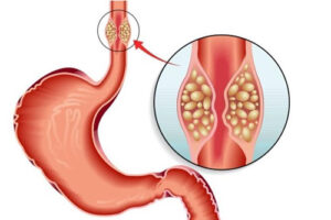 лейомиосаркома 
