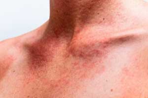 Синдром Сезари