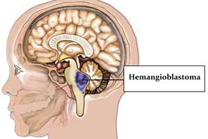 гемангиобластома