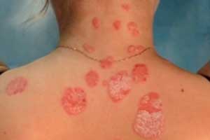 Грибовидный микоз