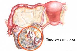 Лечение тератомы в Израиле | Клиника Хадасса