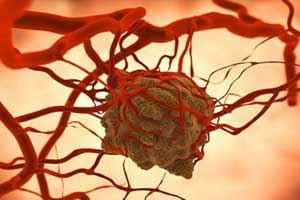 ангиосаркома