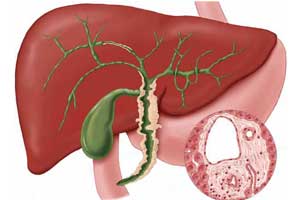 Холангиокарцинома
