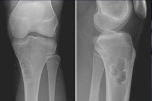 хондромиксоидная фиброма