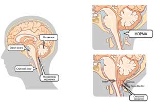 синдром Арнольда Киари