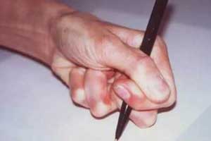 торсионная дистония